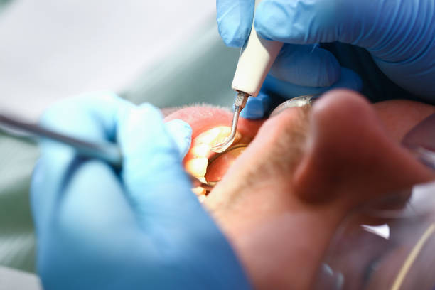 Best Emergency Treatment for Dental Infections or Abscesses in Pacific, WA