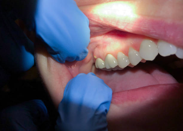 Best Emergency Gum Treatment in Pacific, WA